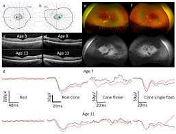 MA04- Evaluación Funcional Visual Neuro Oftalmología Electrofisiología